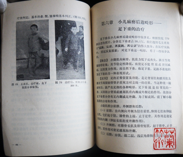《小儿麻痹后遗症穴位刺激结扎疗法》